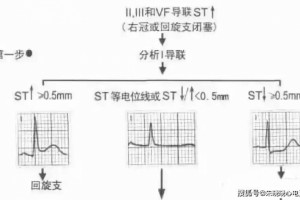 教你快速判别梗死部位和规模